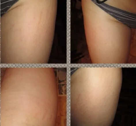 aurmaris-skin-activation-treatment-cellulite-body-wash-results-legs-2-e1645545964465
