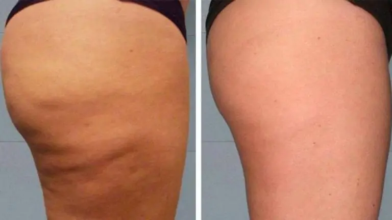 aurmaris-skin-activation-treatment-cellulite-body-wash-results-legs